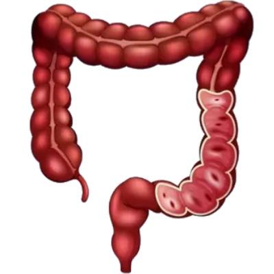 Colon avec RCH